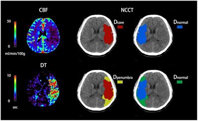 Net water uptake within the ischemic penumbra predicts the presence of the midline shift in patients with acute ischemic stroke